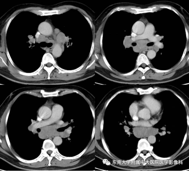 【病例】结节病1例CT