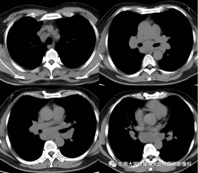 【病例】结节病1例CT