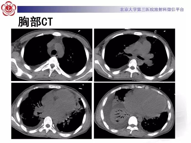 【病例】变应性肉芽肿性多血管炎1例CT