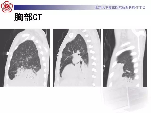 【病例】变应性肉芽肿性多血管炎1例CT