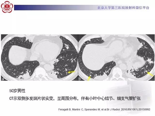 【病例】变应性肉芽肿性多血管炎1例CT