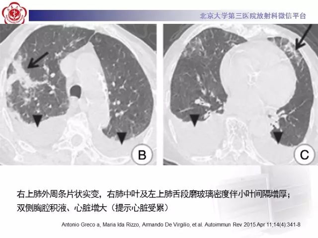 【病例】变应性肉芽肿性多血管炎1例CT