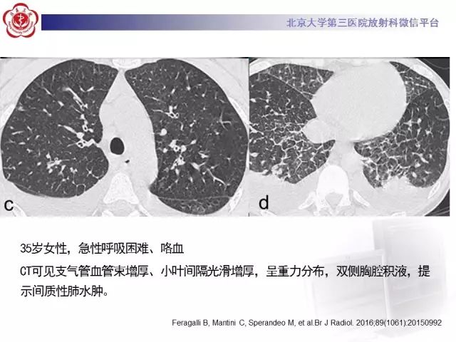 【病例】变应性肉芽肿性多血管炎1例CT