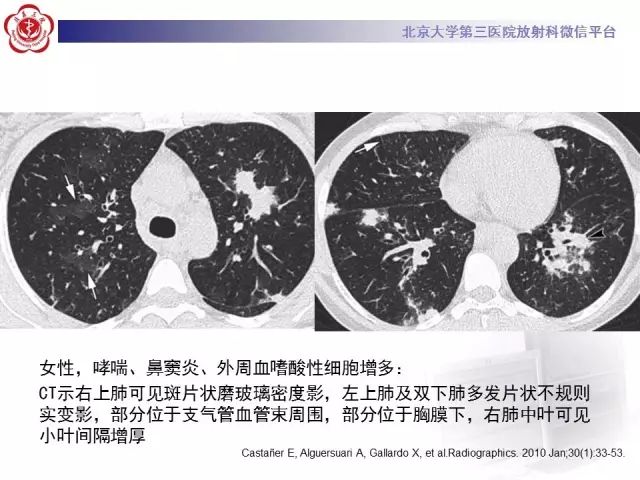 【病例】变应性肉芽肿性多血管炎1例CT
