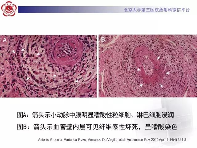 【病例】变应性肉芽肿性多血管炎1例CT