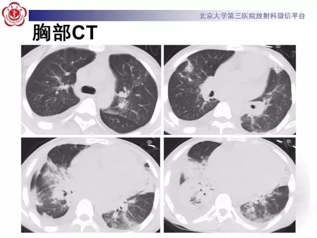 【病例】变应性肉芽肿性多血管炎1例CT
