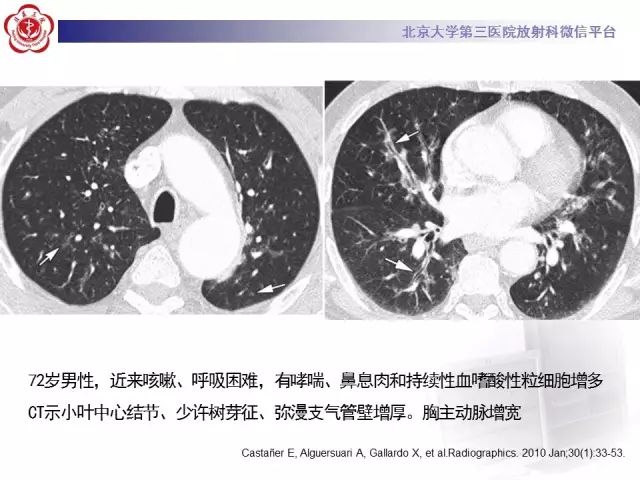 【病例】变应性肉芽肿性多血管炎1例CT