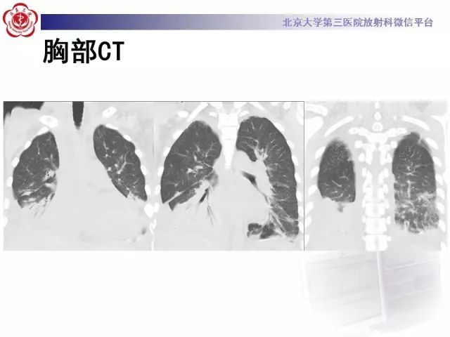 【病例】变应性肉芽肿性多血管炎1例CT