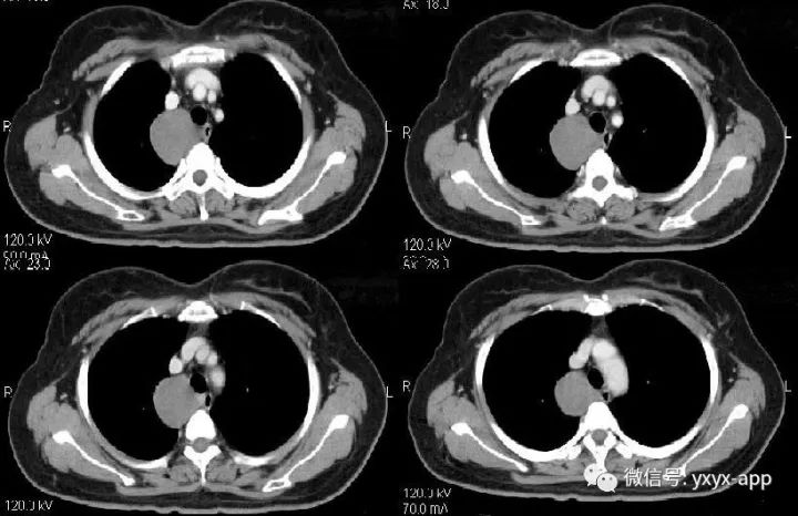 【病例】纵隔支气管囊肿1例CT影像表现