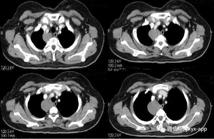 【病例】纵隔支气管囊肿1例CT影像表现
