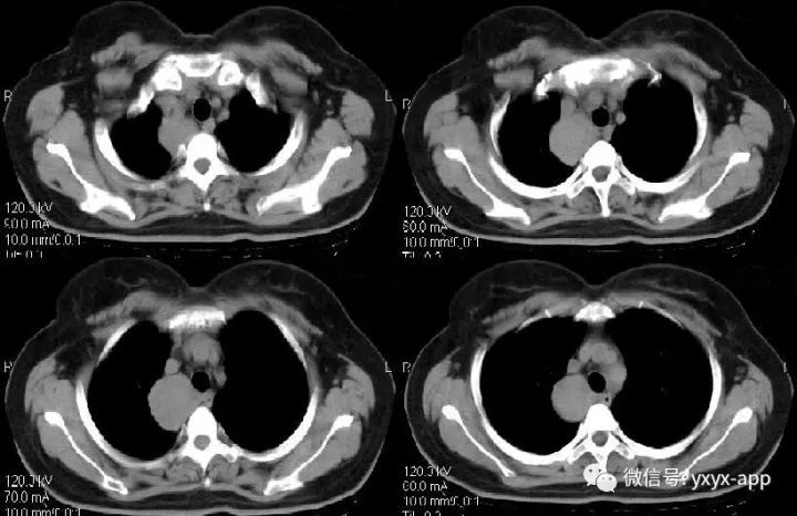 【病例】纵隔支气管囊肿1例CT影像表现