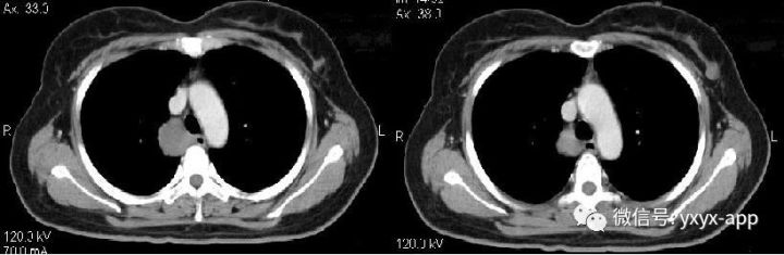 【病例】纵隔支气管囊肿1例CT影像表现