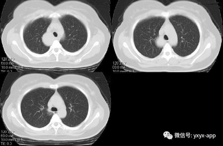 【病例】纵隔支气管囊肿1例CT影像表现