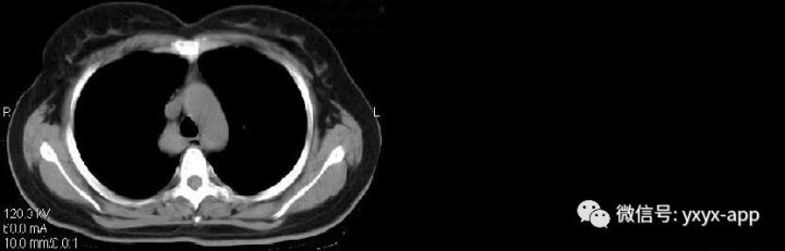 【病例】纵隔支气管囊肿1例CT影像表现