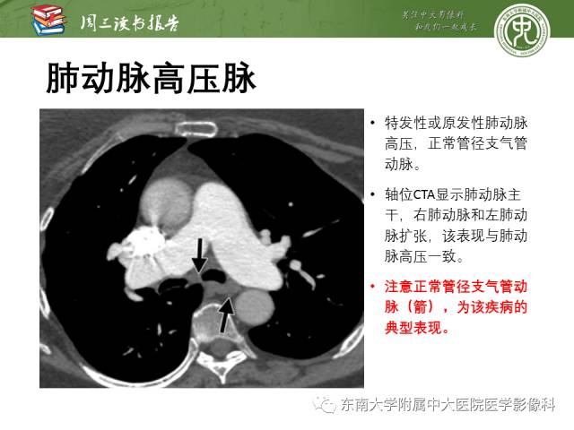 【PPT】支气管动脉：解剖、功能及增粗和异常改变