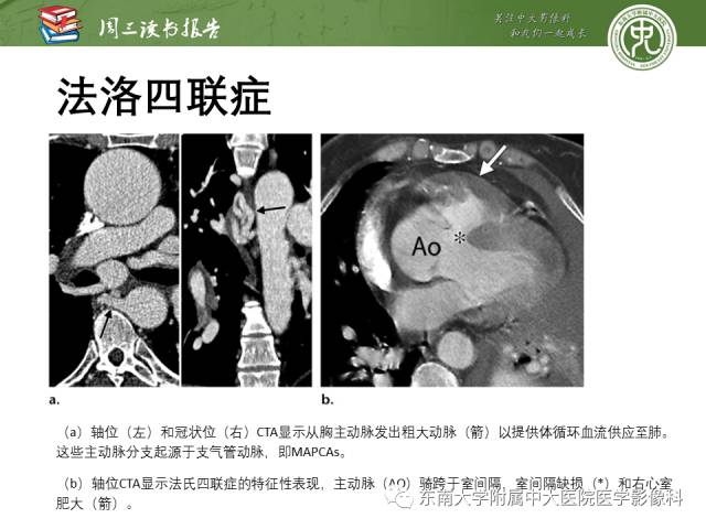 【PPT】支气管动脉：解剖、功能及增粗和异常改变