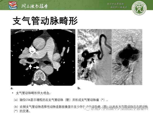 【PPT】支气管动脉：解剖、功能及增粗和异常改变