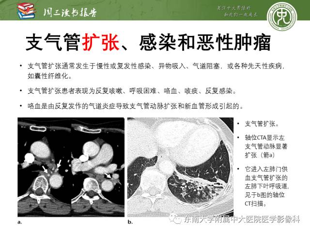 【PPT】支气管动脉：解剖、功能及增粗和异常改变