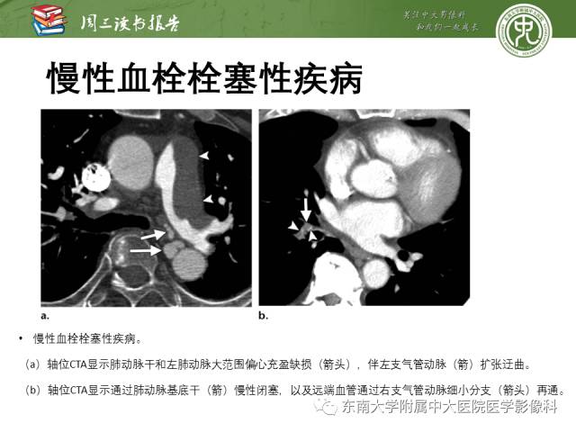 【PPT】支气管动脉：解剖、功能及增粗和异常改变
