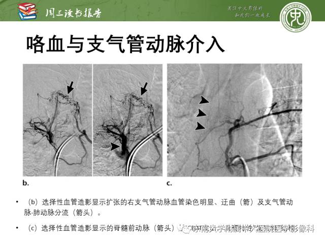 【PPT】支气管动脉：解剖、功能及增粗和异常改变