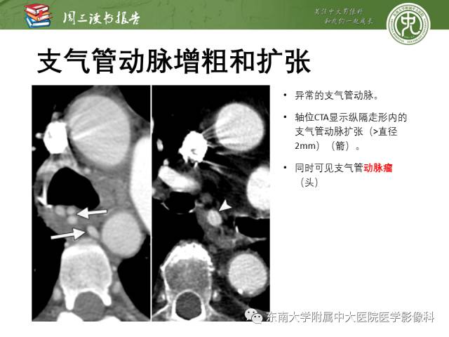 【PPT】支气管动脉：解剖、功能及增粗和异常改变