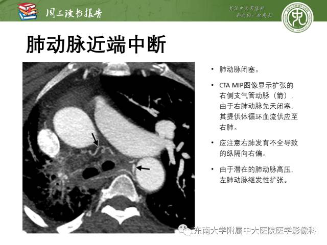 【PPT】支气管动脉：解剖、功能及增粗和异常改变