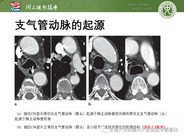 【PPT】支气管动脉：解剖、功能及增粗和异常改变
