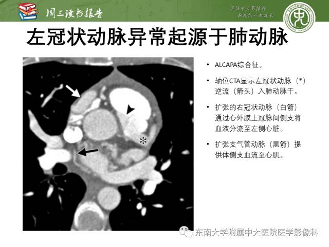 【PPT】支气管动脉：解剖、功能及增粗和异常改变