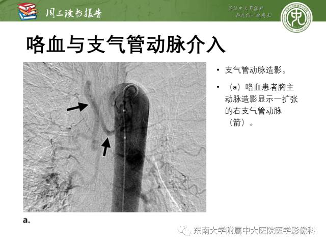 【PPT】支气管动脉：解剖、功能及增粗和异常改变