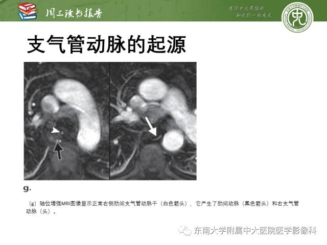 【PPT】支气管动脉：解剖、功能及增粗和异常改变