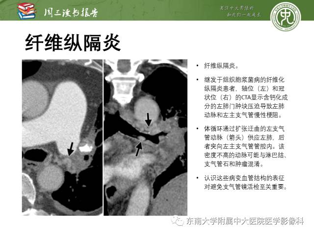 【PPT】支气管动脉：解剖、功能及增粗和异常改变