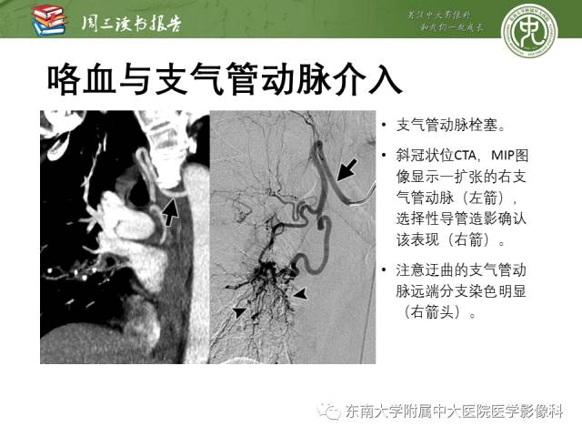 【PPT】支气管动脉：解剖、功能及增粗和异常改变