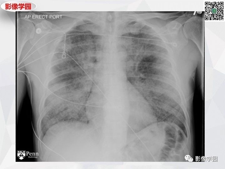 【双语病例】肺泡蛋白沉积症PAP一例CT 【双语病例】肺泡蛋白沉积症PAP一例CT