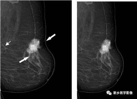 乳腺9大基本病变，必须掌握的基础