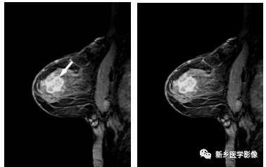 乳腺9大基本病变，必须掌握的基础