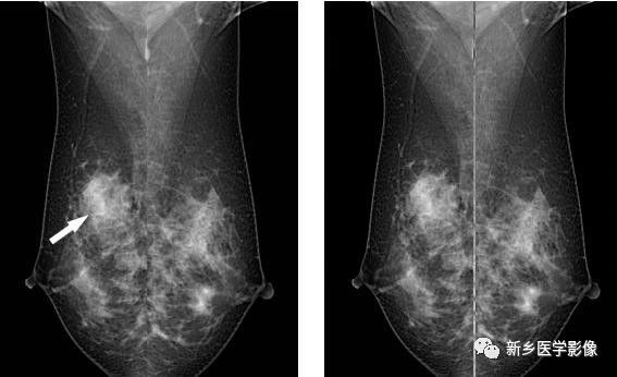 乳腺9大基本病变，必须掌握的基础