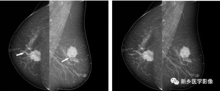 乳腺9大基本病变，必须掌握的基础