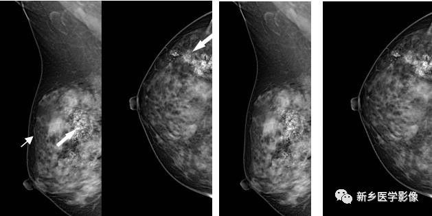 乳腺9大基本病变，必须掌握的基础