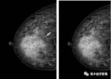 乳腺9大基本病变，必须掌握的基础