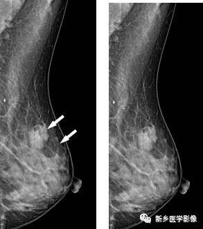 乳腺9大基本病变，必须掌握的基础
