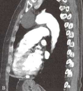 胸腺囊肿 胸腺囊肿