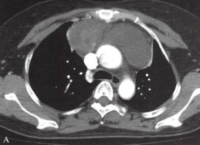 胸腺囊肿 胸腺囊肿