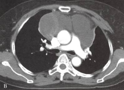 胸腺囊肿 胸腺囊肿