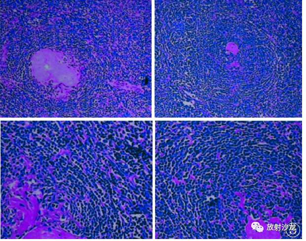 【病例】纵隔巨淋巴结增生症1例CT影像表现 【病例】纵隔巨淋巴结增生症1例CT影像表现