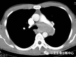 【病例】纵隔巨淋巴结增生症1例CT影像表现