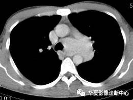 【病例】纵隔巨淋巴结增生症1例CT影像表现