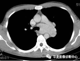 【病例】纵隔巨淋巴结增生症1例CT影像表现