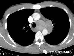 【病例】纵隔巨淋巴结增生症1例CT影像表现