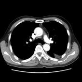 【病例】肺肉瘤样癌1例CT影像表现