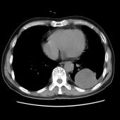 【病例】肺肉瘤样癌1例CT影像表现